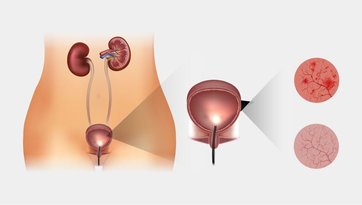 akut és krónikus cystitis