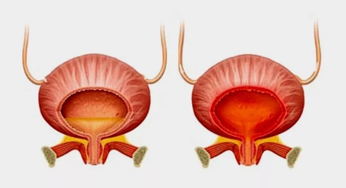 Normál hólyag (balra) és hólyaggyulladás cystitissel (jobbra)
